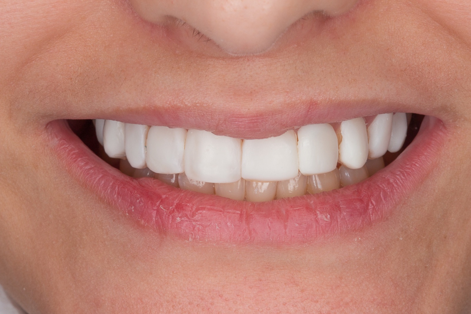 Antes — Lentes de Contato Dental