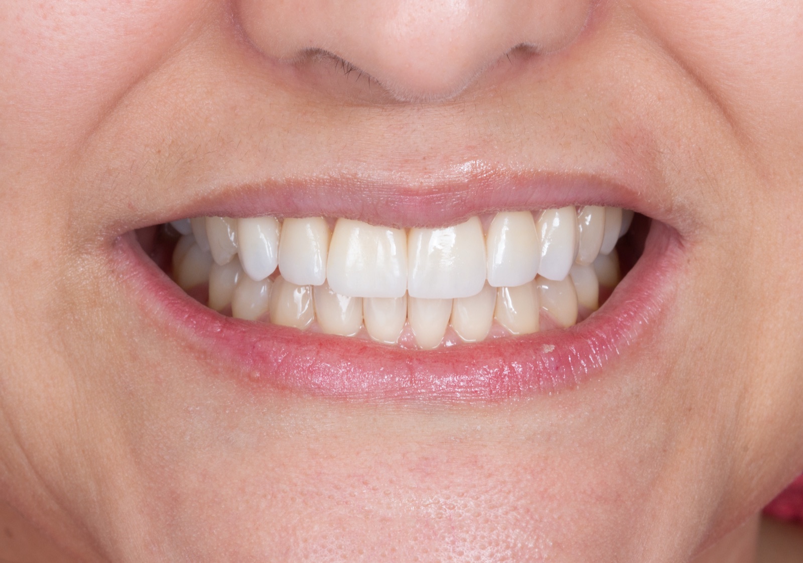 Depois — Lentes de Contato Dental