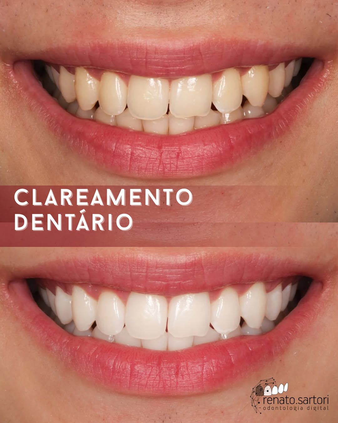 Resultado real de clareamento dentário — Dr. Renato Sartori