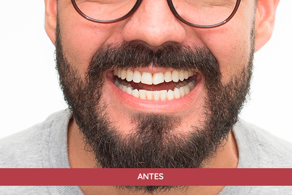 antes