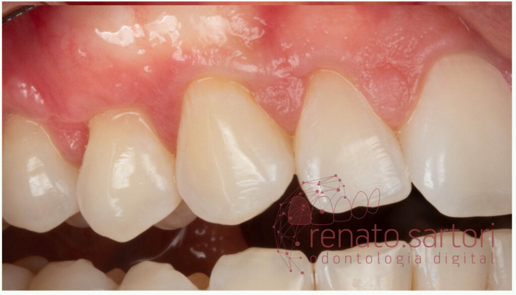 cirurgia_gengival_recobrimento_radicular_gengiva_1_lente_de_contato_dental_renato_sartori_itaim_bibi_faria_lima_odontologia_digital-3