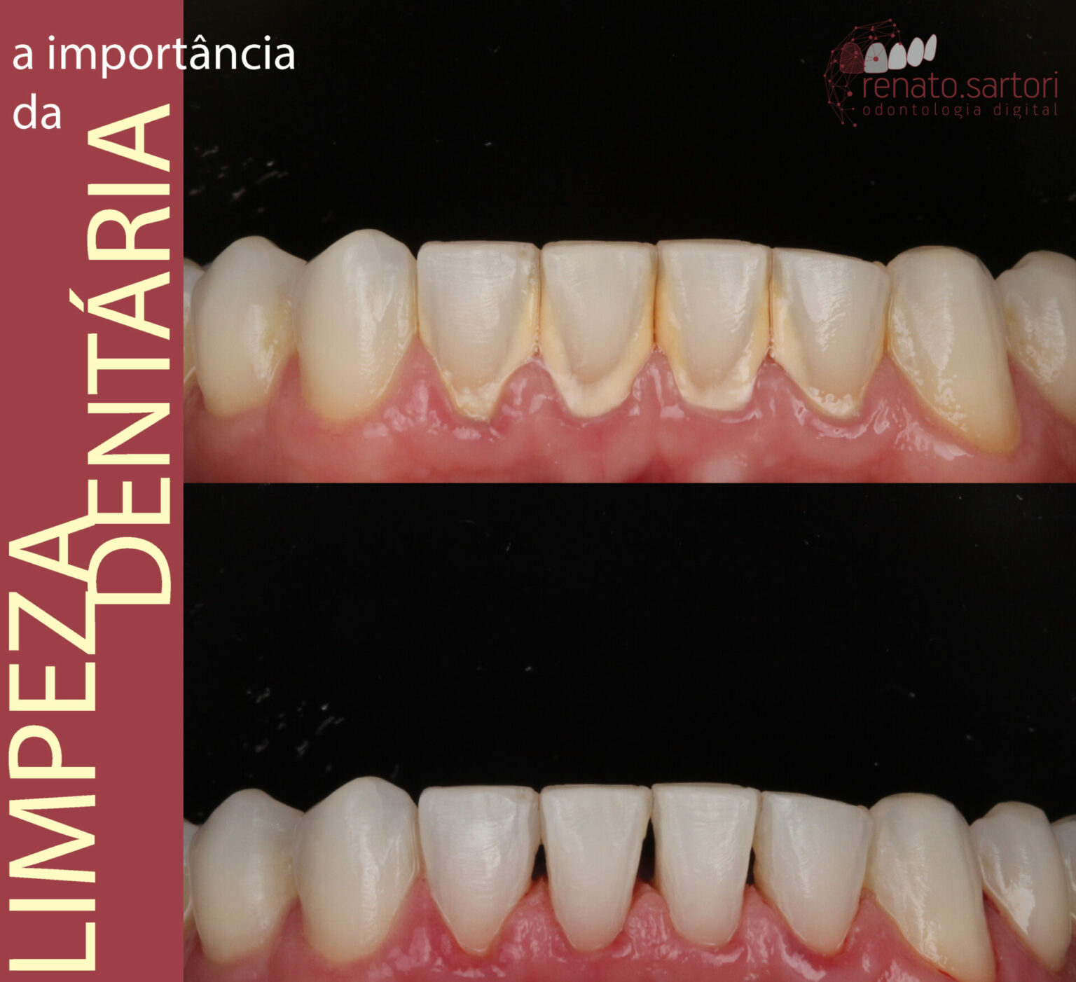 Limpeza Dentária Dr. Renato Sartori Odontologia Digital